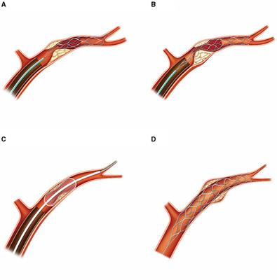 Mechanical thrombectomy using the retrograde semi-retrieval technique for patients with underlying intracranial atherosclerotic stenosis